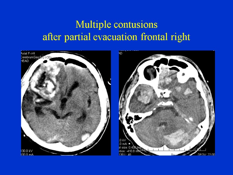 Multiple contusions after partial evacuation frontal right